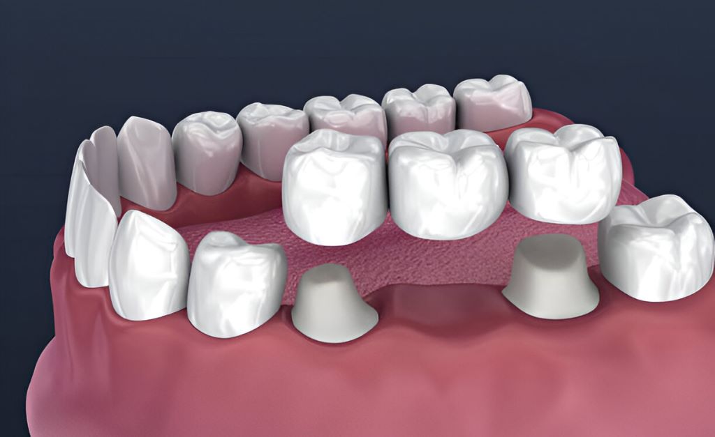 dental crowns and bridges near you in etobicoke