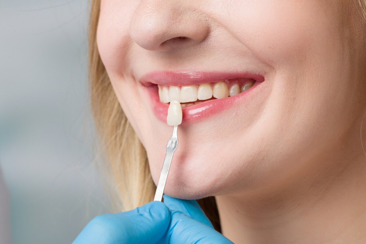 dental veneers near you in etobicoke