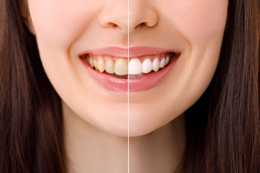 teeth whitening near you in etobicoke