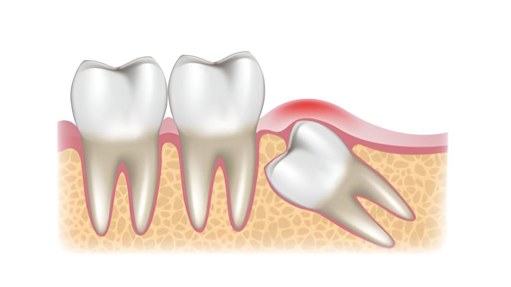 wisdom teeth extraction near you in etobicoke