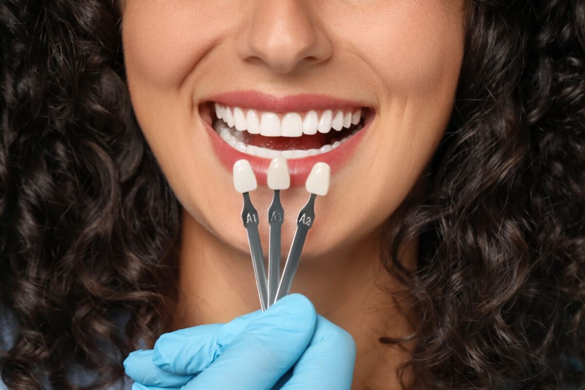 top benefits of dental veneers in etobicoke