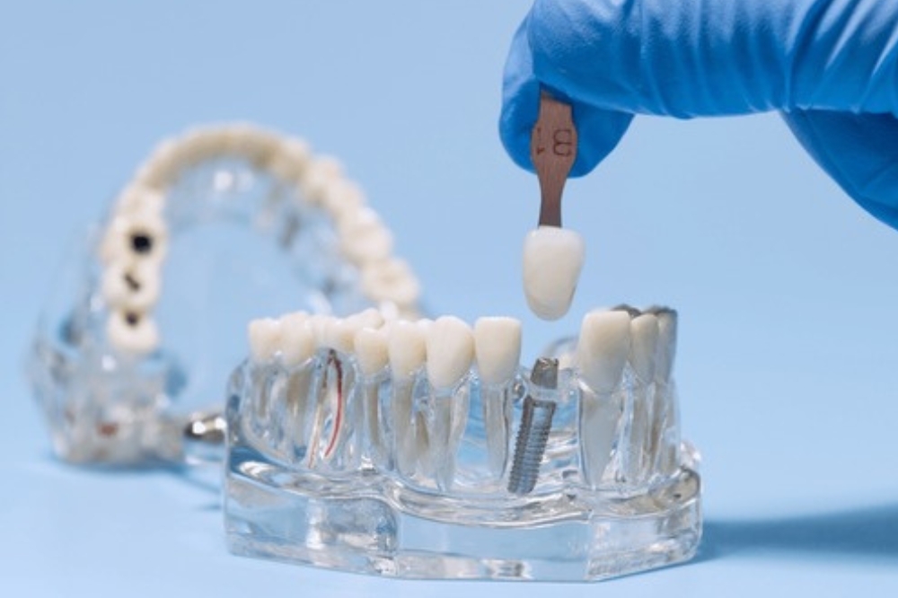 Healing After Dental Implants: Timeline and Care Tips