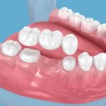 dental bridges explained a reliable way to replace missing teeth