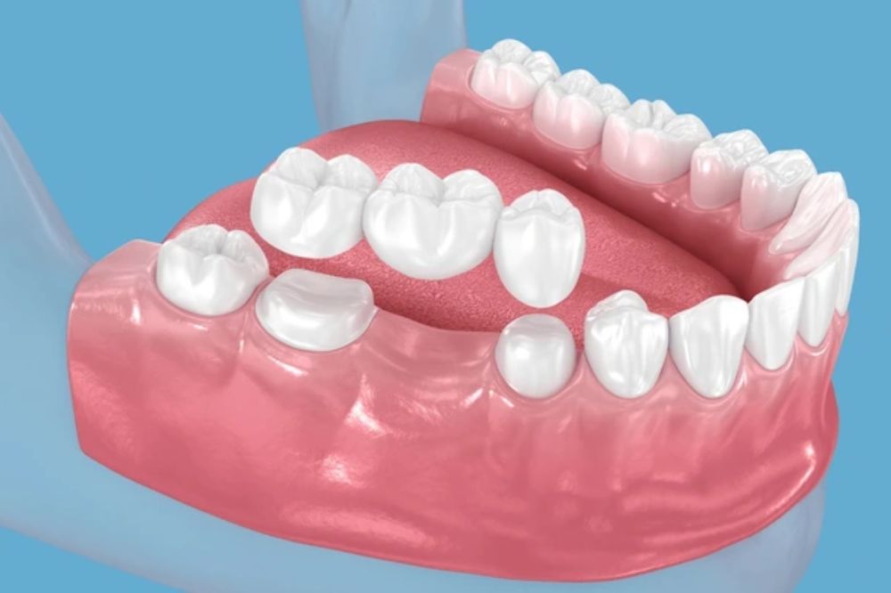 dental bridges explained a reliable way to replace missing teeth