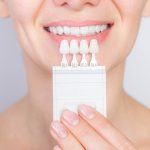 dental veneer near you