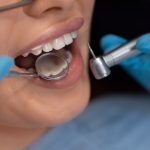 how long composite fillings last